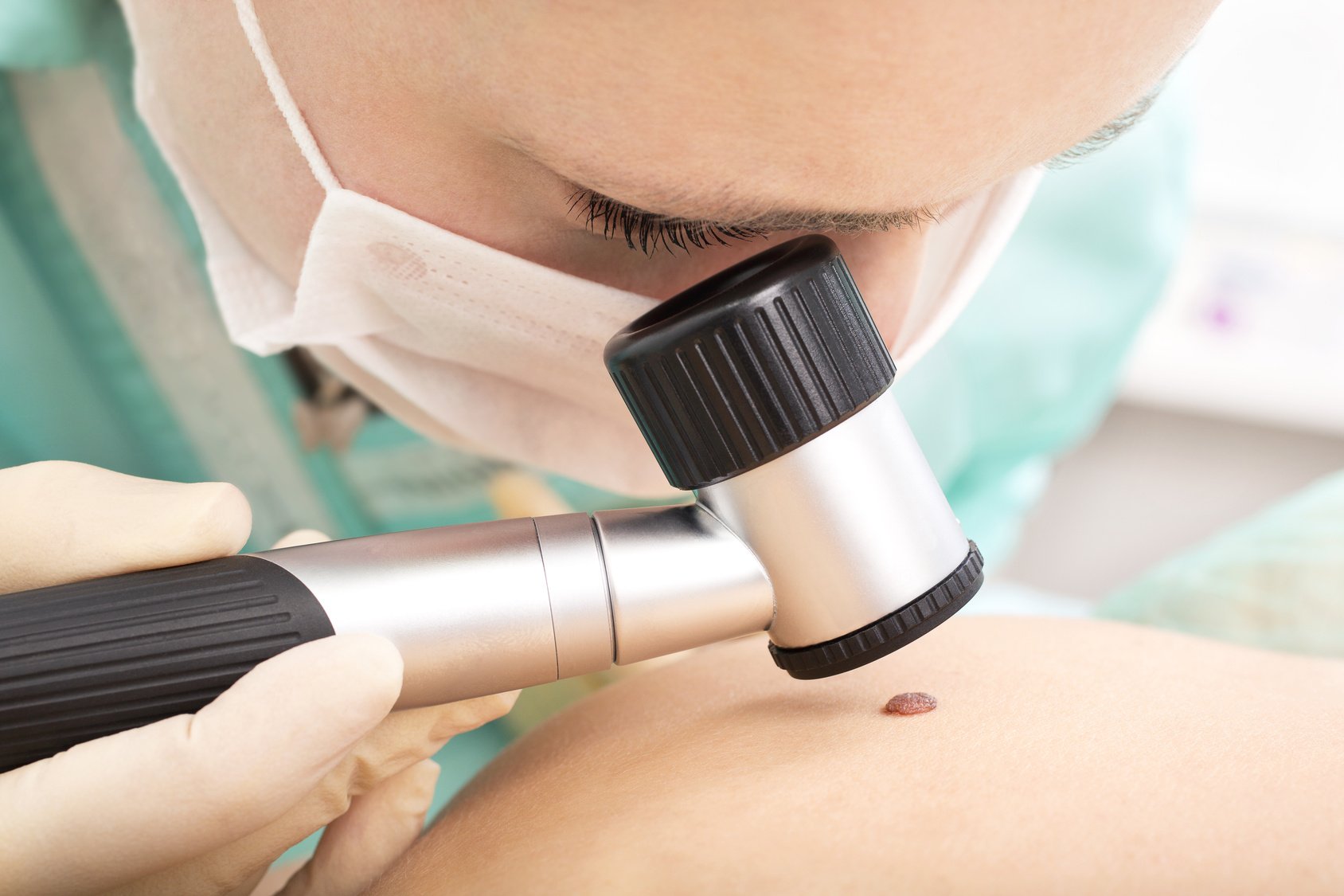 examines birthmark with dermatoscope