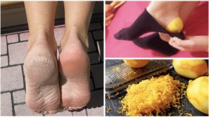 Laita sitruunankuoret kantapäihisi yön ajaksi: Lue millaiset vaikutukset sillä on Sitruuna