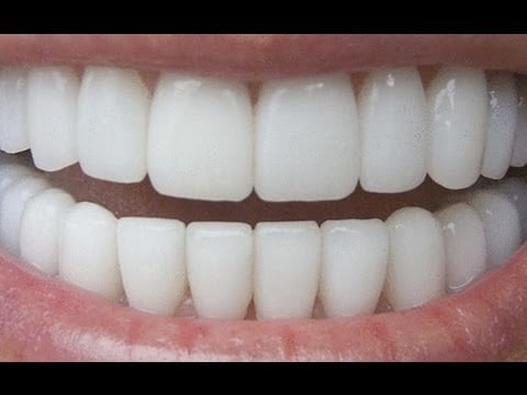 Video: Näin saat valkoiset hampaat vain 3 minuutissa