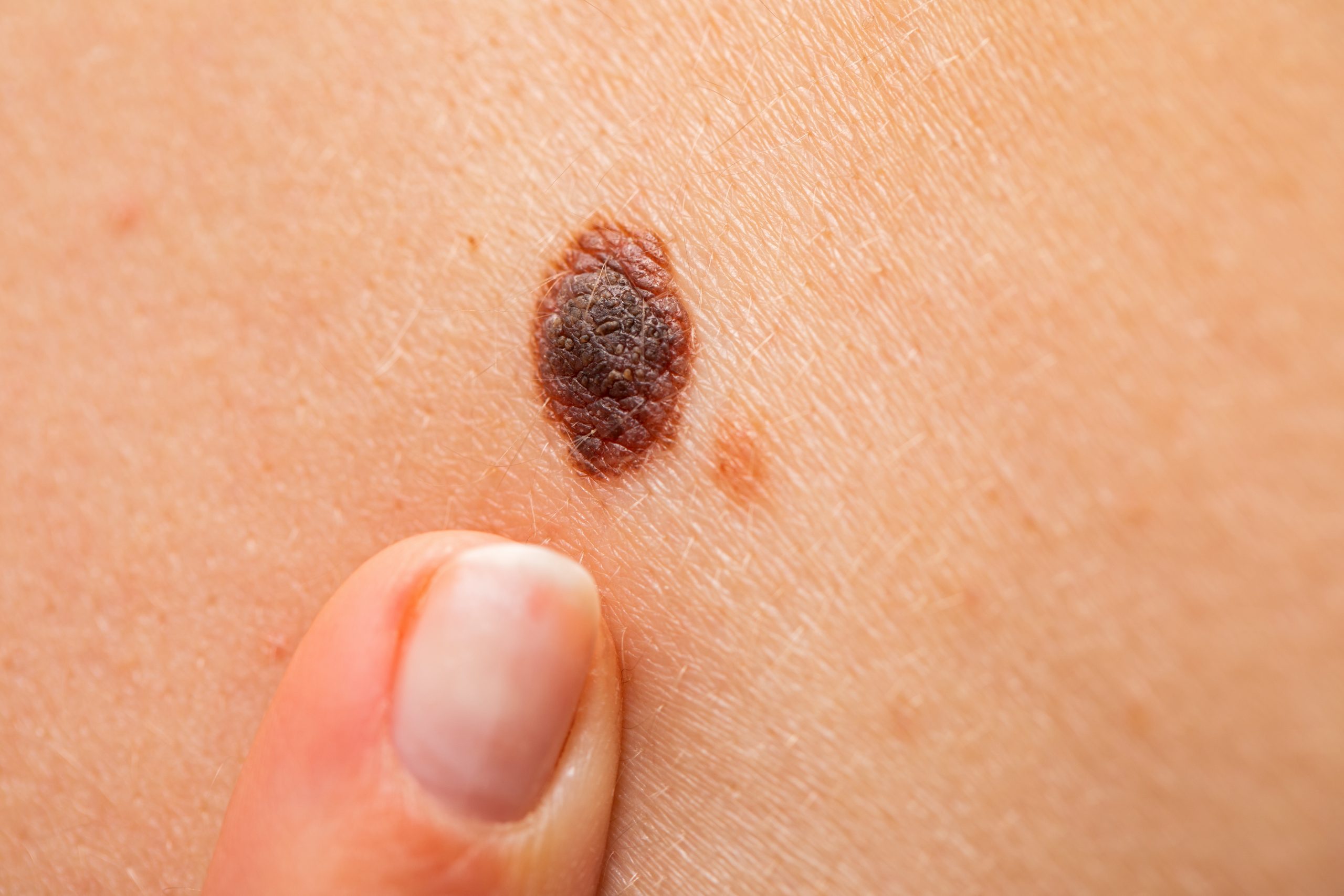 Dangerous nevus on skin – melanoma