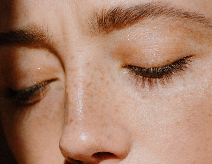 Freckles on woman